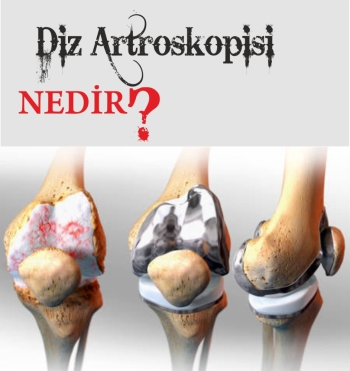 Artroskopi Nedir?